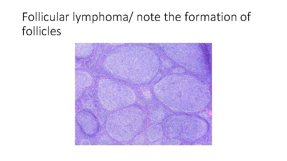 Follicular lymphoma/ note the formation of follicles 