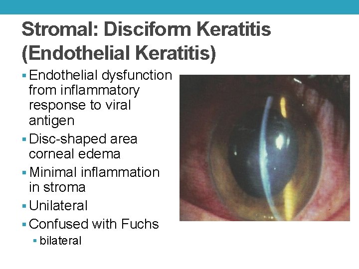 Stromal: Disciform Keratitis (Endothelial Keratitis) § Endothelial dysfunction from inflammatory response to viral antigen Stromal: Disciform Keratitis (Endothelial Keratitis) § Endothelial dysfunction from inflammatory response to viral antigen