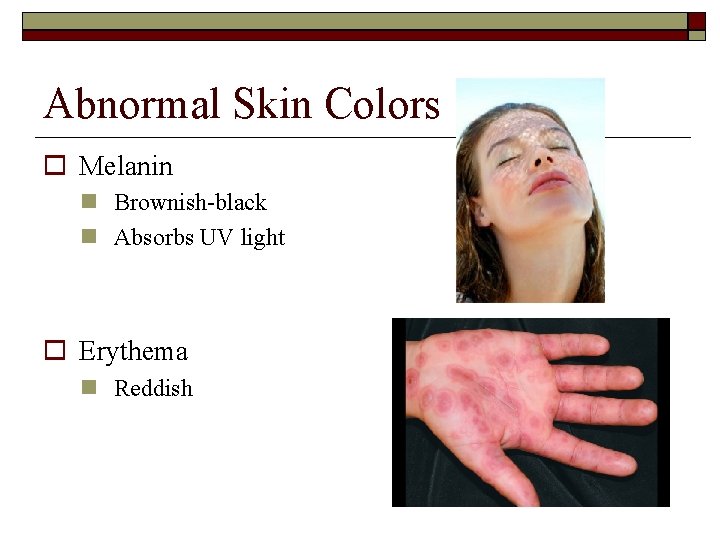 Abnormal Skin Colors Melanin Brownish-black Absorbs UV light Erythema Reddish 