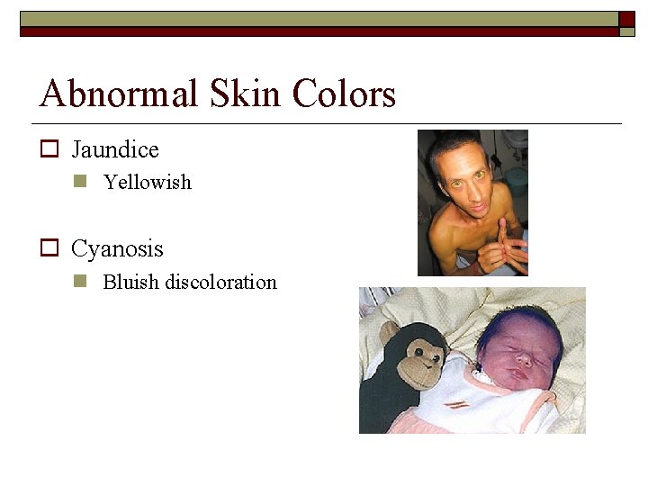 Abnormal Skin Colors Jaundice Yellowish Cyanosis Bluish discoloration 