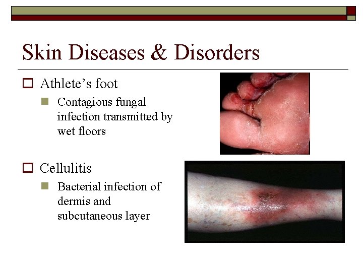 Skin Diseases & Disorders Athlete’s foot Contagious fungal infection transmitted by wet floors Cellulitis