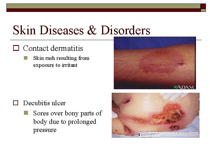 Skin Diseases & Disorders Contact dermatitis Skin rash resulting from exposure to irritant Decubitis