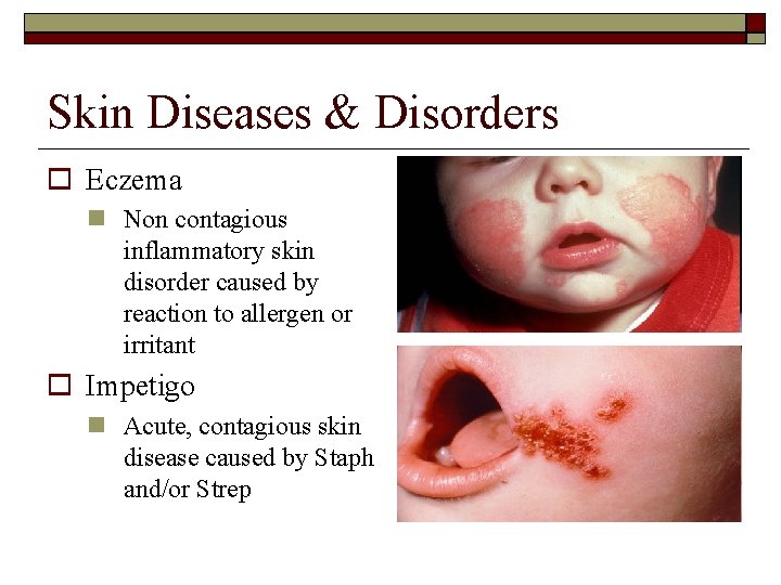 Skin Diseases & Disorders Eczema Non contagious inflammatory skin disorder caused by reaction to