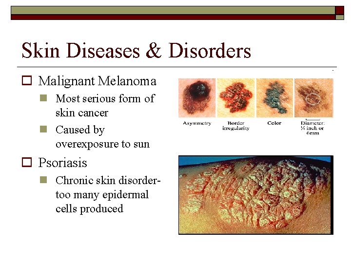 Skin Diseases & Disorders Malignant Melanoma Most serious form of skin cancer Caused by