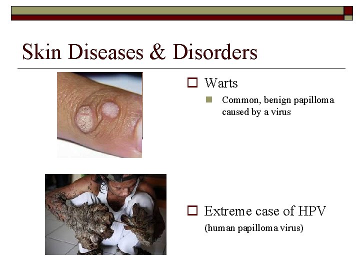 Skin Diseases & Disorders Warts Common, benign papilloma caused by a virus Extreme case
