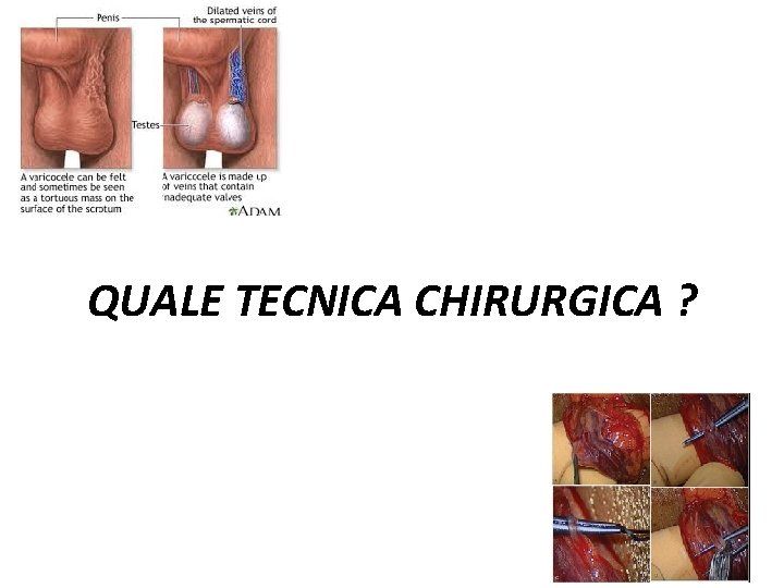 QUALE TECNICA CHIRURGICA ? 