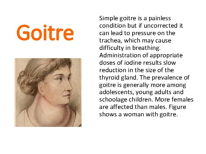 Goitre Simple goitre is a painless condition but if uncorrected it can lead to