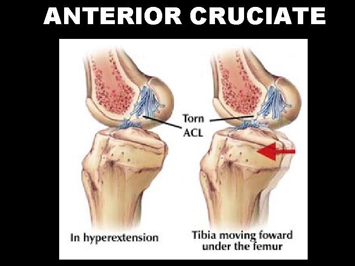 ANTERIOR CRUCIATE 