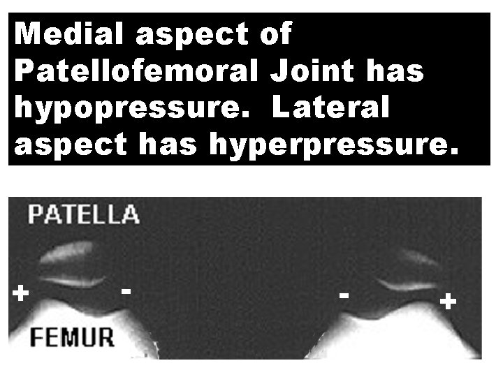 Medial aspect of Patellofemoral Joint has hypopressure. Lateral aspect has hyperpressure. + - -