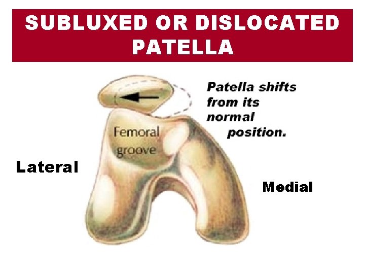 SUBLUXED OR DISLOCATED PATELLA Lateral Medial 