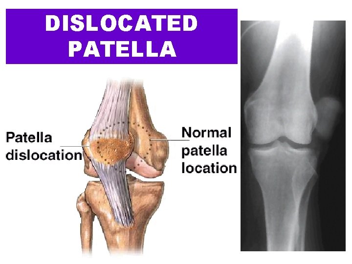 DISLOCATED PATELLA 