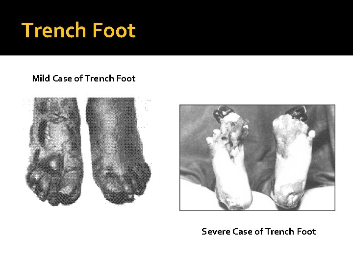 Trench Foot Mild Case of Trench Foot Severe Case of Trench Foot 