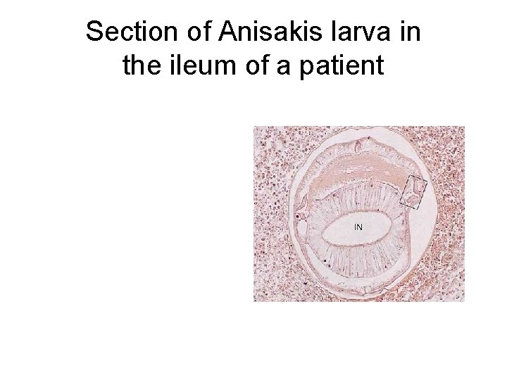 Section of Anisakis larva in the ileum of a patient 
