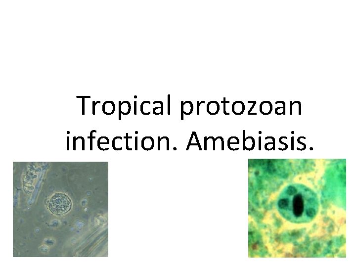 Tropical protozoan infection. Amebiasis. 