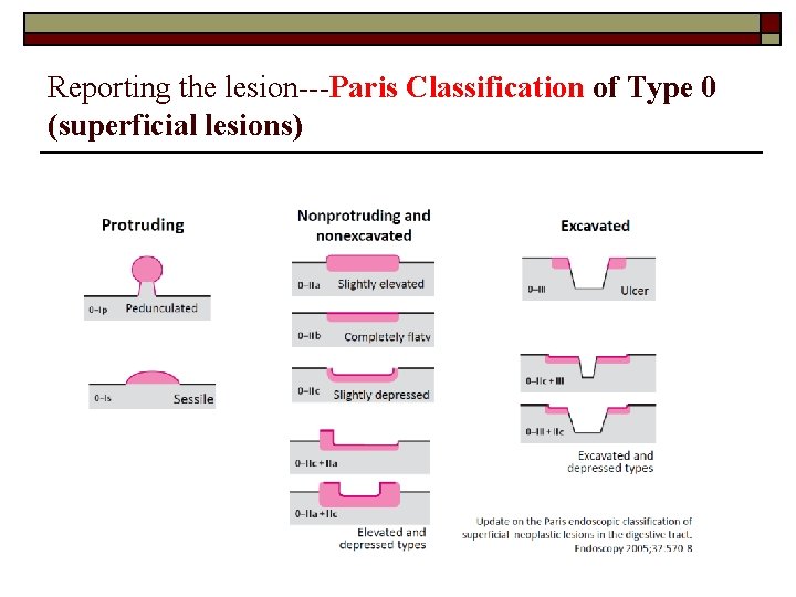 Reporting the lesion---Paris Classification of Type 0 (superficial lesions) 