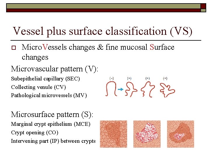 Vessel plus surface classification (VS) Micro. Vessels changes & fine mucosal Surface changes Microvascular