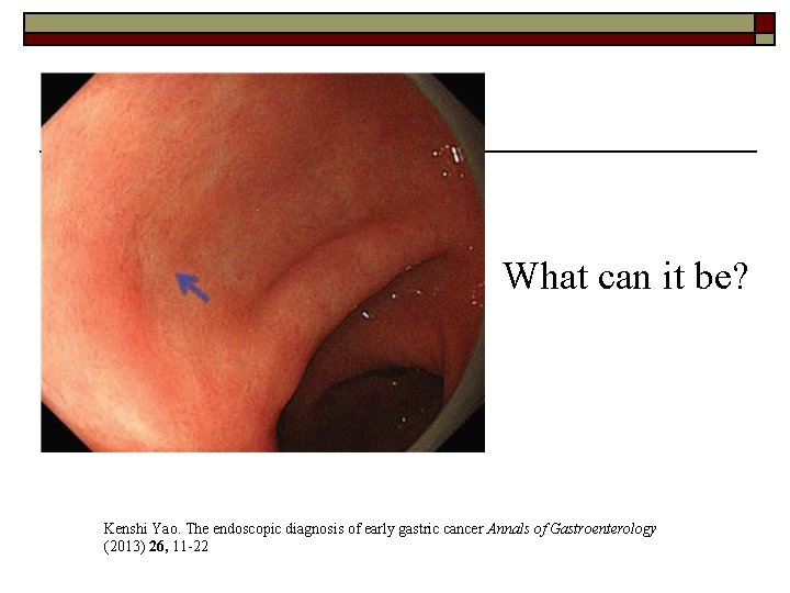 What can it be? Kenshi Yao. The endoscopic diagnosis of early gastric cancer Annals