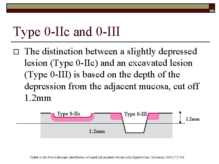 Type 0 -IIc and 0 -III o The distinction between a slightly depressed lesion