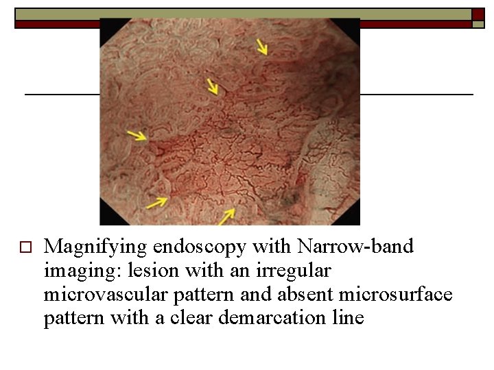 o Magnifying endoscopy with Narrow-band imaging: lesion with an irregular microvascular pattern and absent