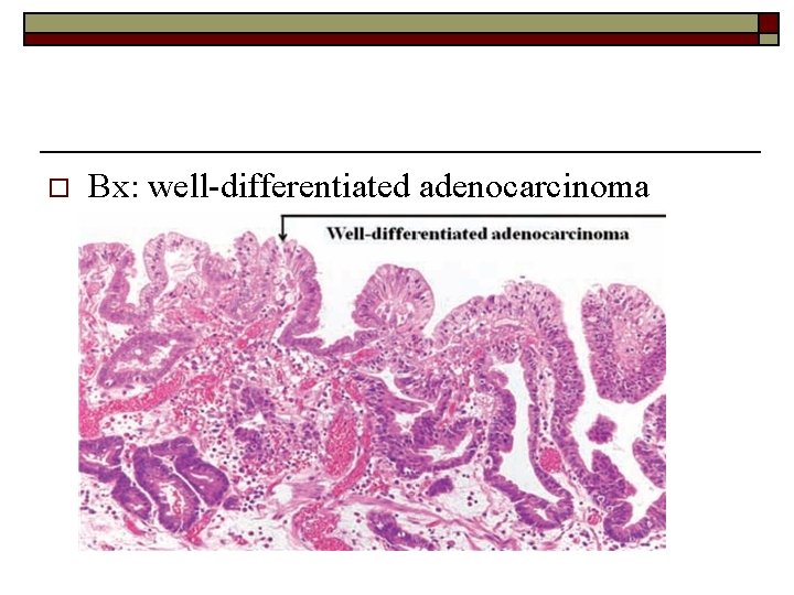 o Bx: well-differentiated adenocarcinoma 