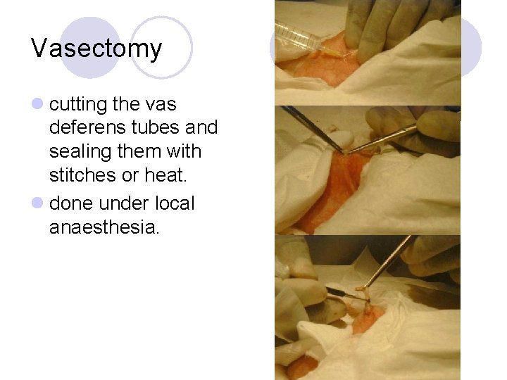 Vasectomy l cutting the vas deferens tubes and sealing them with stitches or heat.