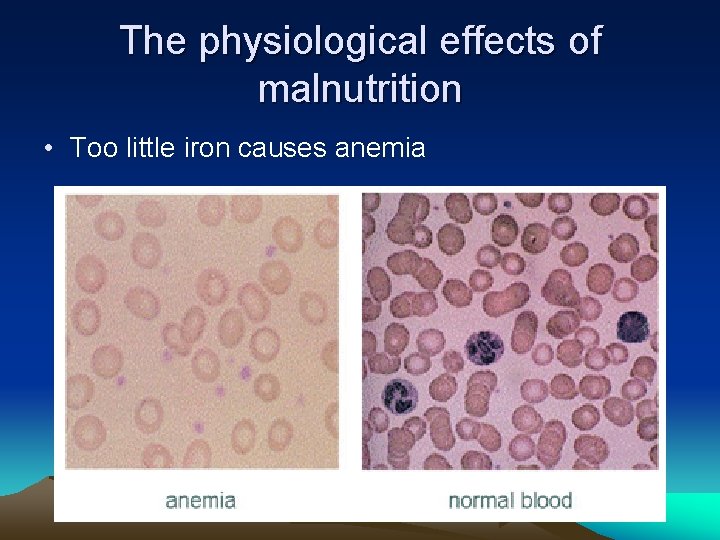 The physiological effects of malnutrition • Too little iron causes anemia 