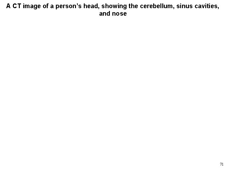 A CT image of a person’s head, showing the cerebellum, sinus cavities, and nose