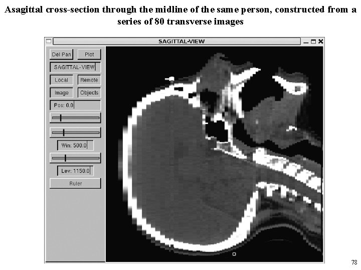 Asagittal cross-section through the midline of the same person, constructed from a series of