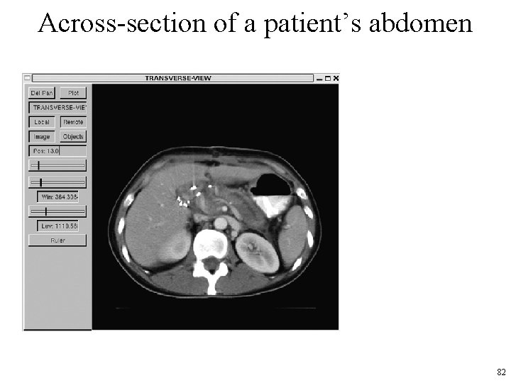 Across-section of a patient’s abdomen 82 