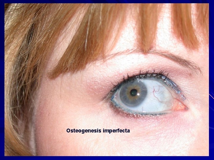 Osteogenesis imperfecta 