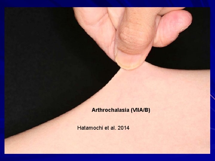 Arthrochalasia (VIIA/B) Hatamochi et al. 2014 