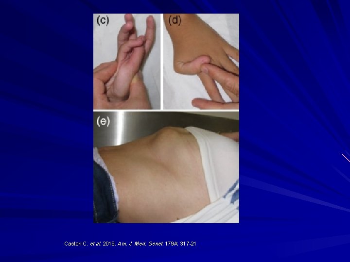 Castori C. et al. 2019. Am. J. Med. Genet. 179 A: 317 -21 