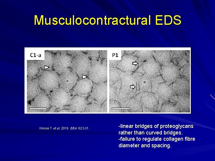 Musculocontractural EDS Hirose T et al. 2019. BBA. 623 -31. -linear bridges of proteoglycans