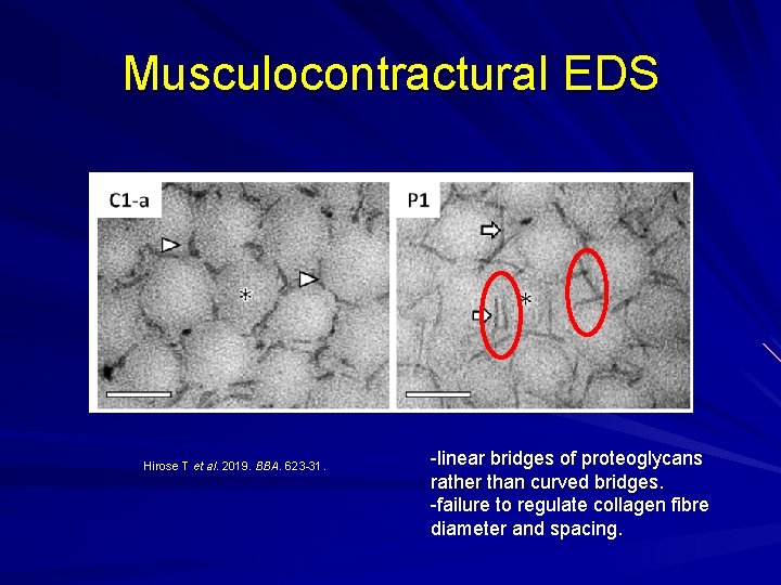 Musculocontractural EDS Hirose T et al. 2019. BBA. 623 -31. -linear bridges of proteoglycans