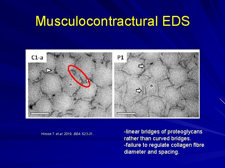 Musculocontractural EDS Hirose T et al. 2019. BBA. 623 -31. -linear bridges of proteoglycans