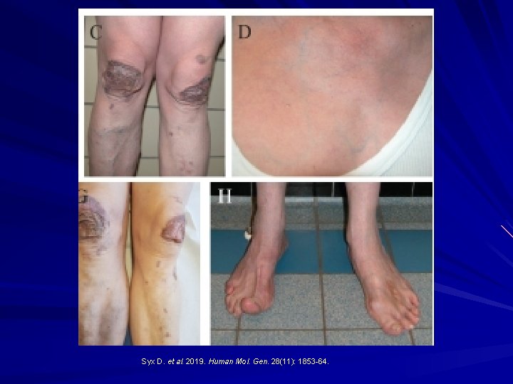 Syx D. et al. 2019. Human Mol. Gen. 28(11): 1853 -64. 