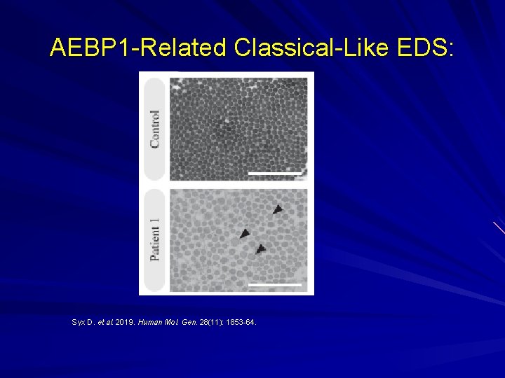 AEBP 1 -Related Classical-Like EDS: Syx D. et al. 2019. Human Mol. Gen. 28(11):