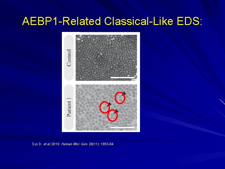 AEBP 1 -Related Classical-Like EDS: Syx D. et al. 2019. Human Mol. Gen. 28(11):
