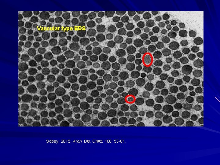 Vascular type EDS Sobey, 2015. Arch. Dis. Child. 100: 57 -61. 