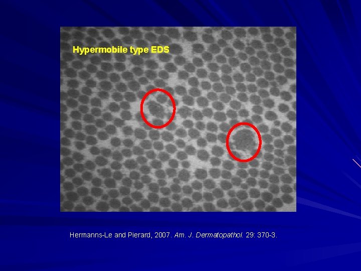 Hypermobile type EDS Hermanns-Le and Pierard, 2007. Am. J. Dermatopathol. 29: 370 -3. 