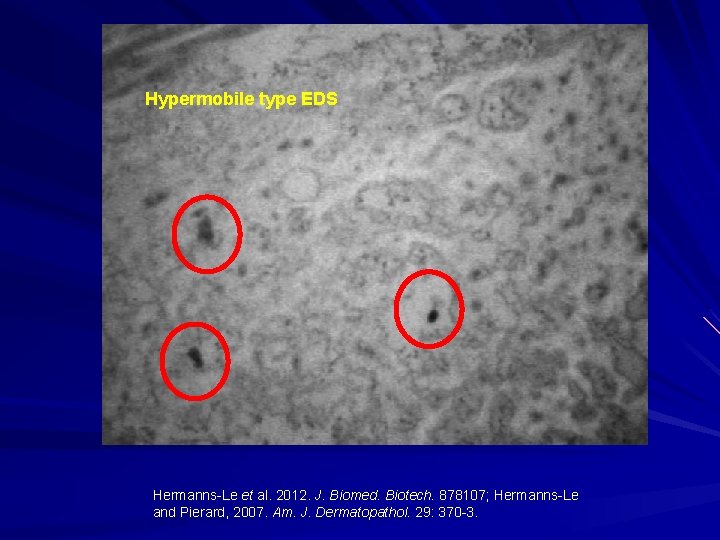 Hypermobile type EDS Hermanns-Le et al. 2012. J. Biomed. Biotech. 878107; Hermanns-Le and Pierard,