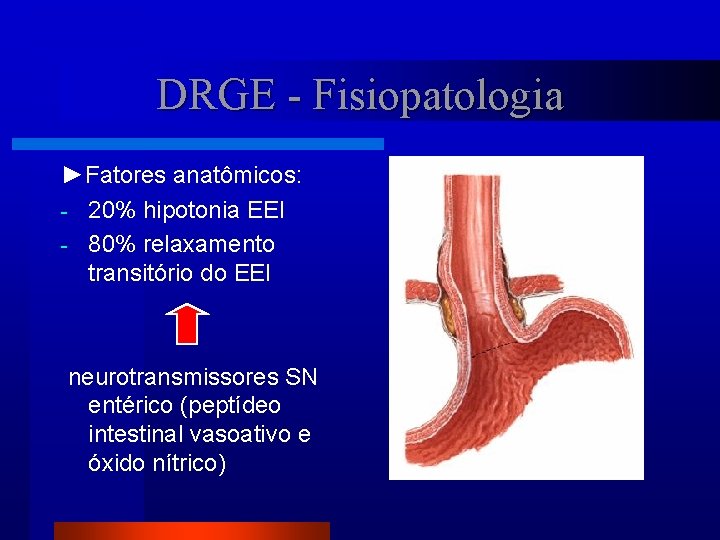 DRGE - Fisiopatologia ►Fatores anatômicos: - 20% hipotonia EEI - 80% relaxamento transitório do