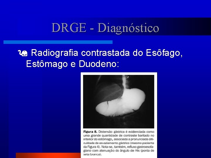 DRGE - Diagnóstico Radiografia contrastada do Esôfago, Estômago e Duodeno: 