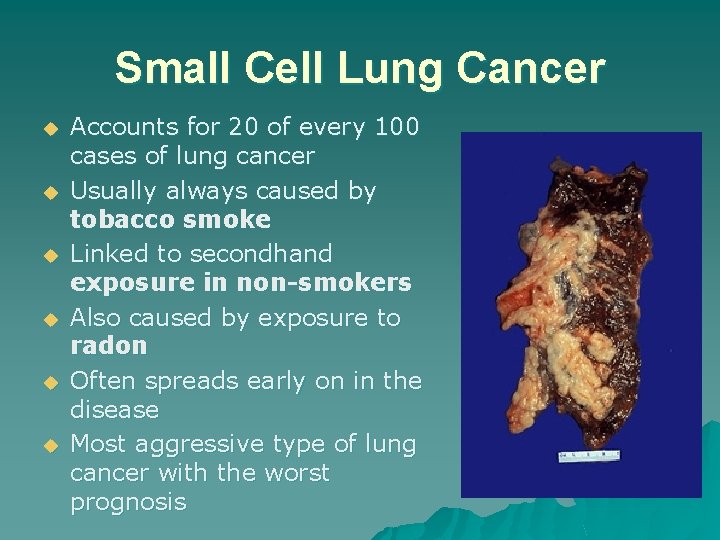 Small Cell Lung Cancer u u u Accounts for 20 of every 100 cases