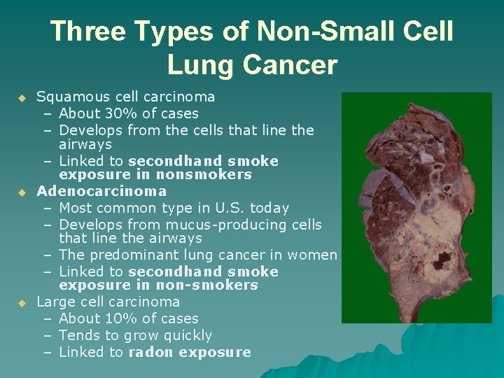 Three Types of Non-Small Cell Lung Cancer u u u Squamous cell carcinoma –