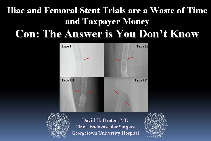 Iliac and Femoral Stent Trials are a Waste of Time and Taxpayer Money Con: