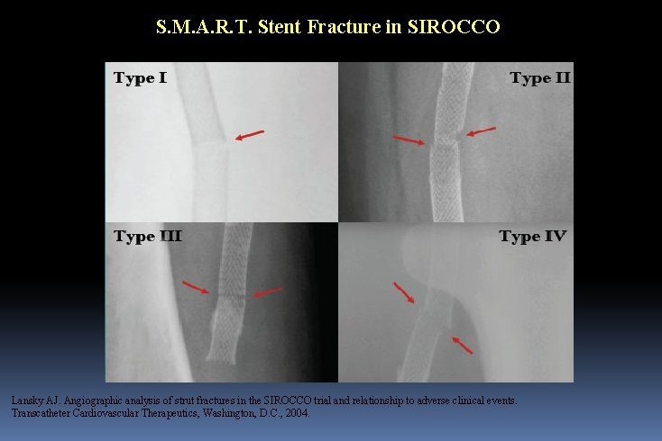 S. M. A. R. T. Stent Fracture in SIROCCO Lansky AJ. Angiographic analysis of