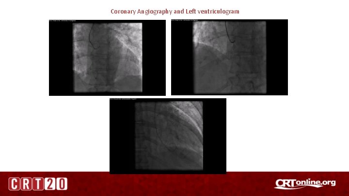 Coronary Angiography and Left ventriculogram 