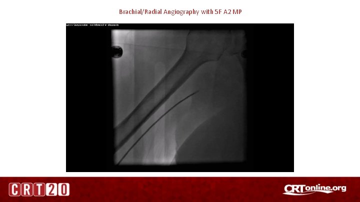 Brachial/Radial Angiography with 5 F A 2 MP 