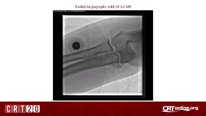 Radial Angiography with 5 F A 2 MP 
